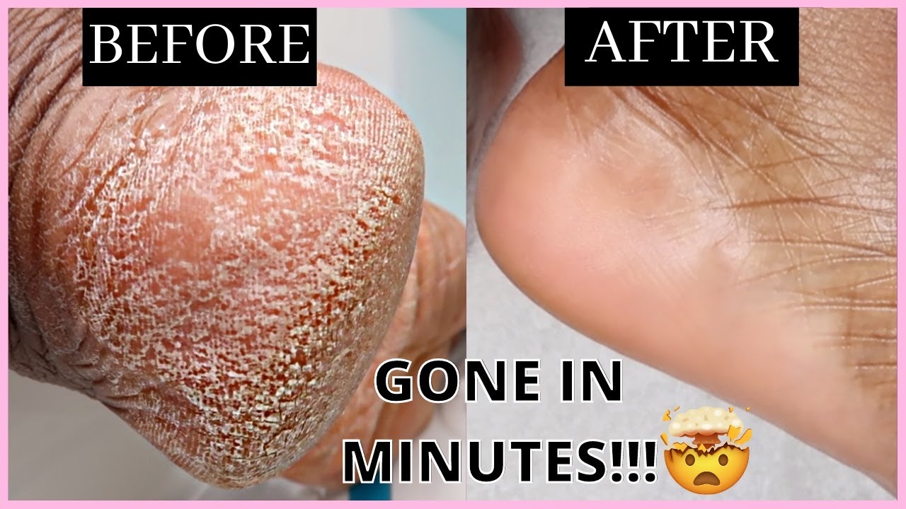 How to Remove Dead Skin Cells from Your Feet in Minutes | Self Care Routine