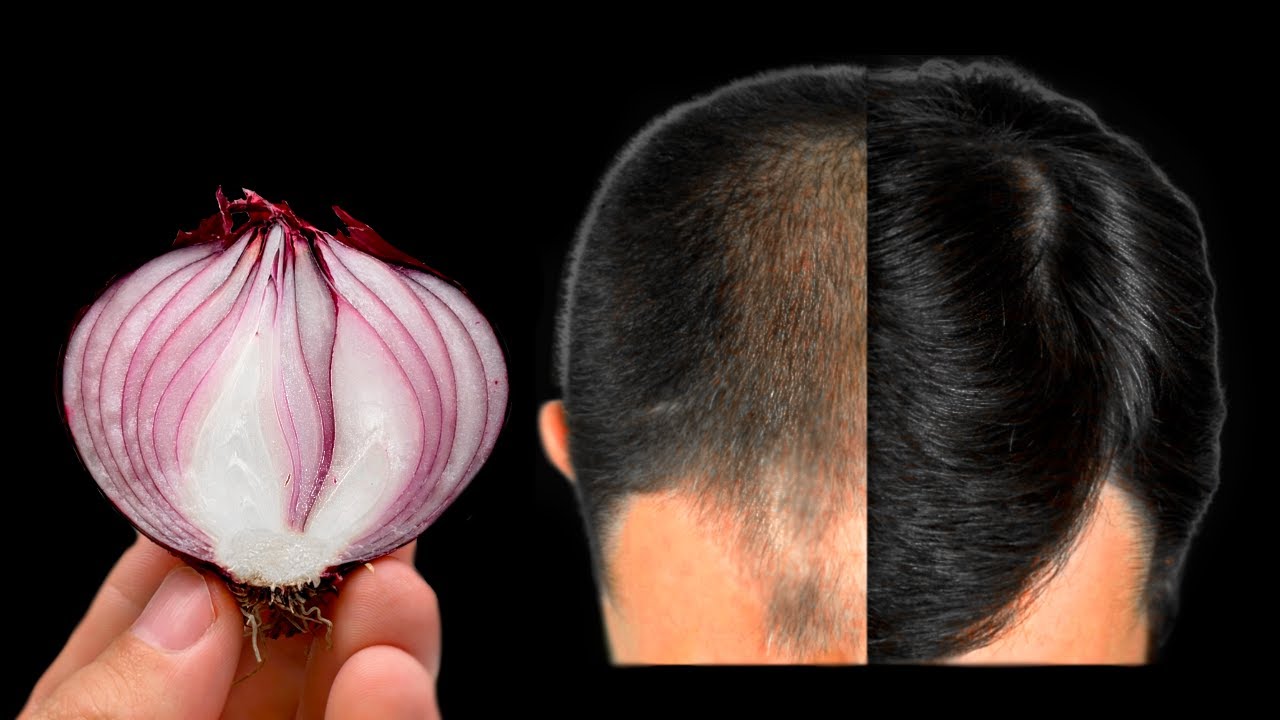 Hair Grows Like Crazy and Doesn’t Fall Out! This is a Powerful Remedy with the Strongest Ingredients – Including Red Onion