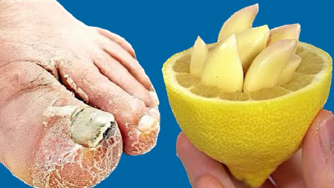 Nail Fungus Removal: Natural Garlic and Lemon Treatment