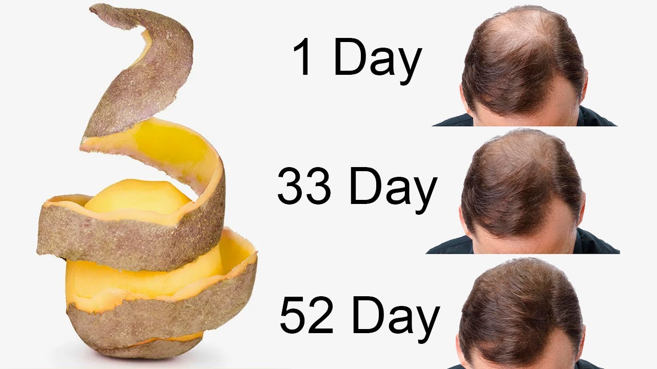 I Didn’t Expect It! The Hair on My Bald Spot is Growing Like Crazy – Thanks to Potato Peels!