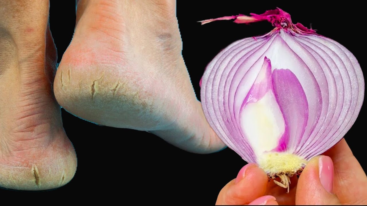 Remove Cracked Heels and Get Beautiful Feet Forever: A Magical Home Remedy with Red Onion