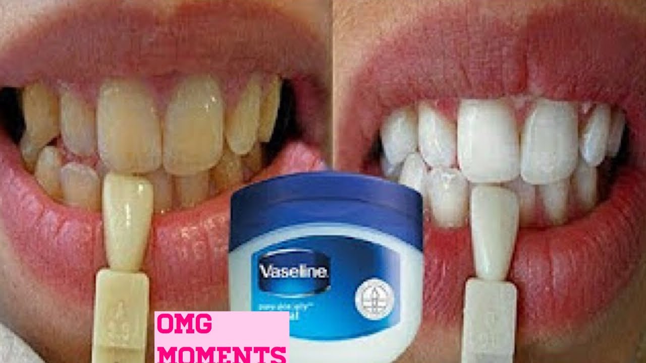 Brighten Your Smile Naturally: How to Use Vaseline for Whiter Teeth