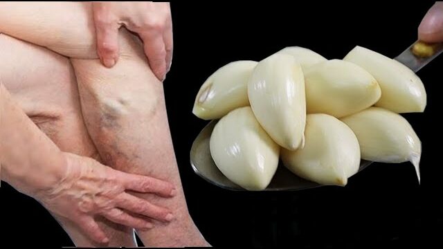 Leg Pain, Rheumatism, Varicose Veins, Arthritis, Headache, Joint Pain – Mom’s Natural Remedy