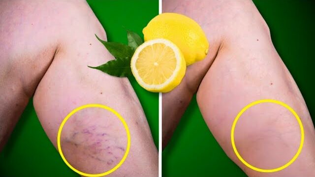 Lemon Removes Varicose Veins! Just Do This Every Day…