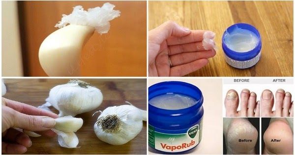 Amazing Uses of Vicks Vaporub