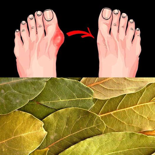 Natural Home Remedy for Foot Bumps and Protruding Bones