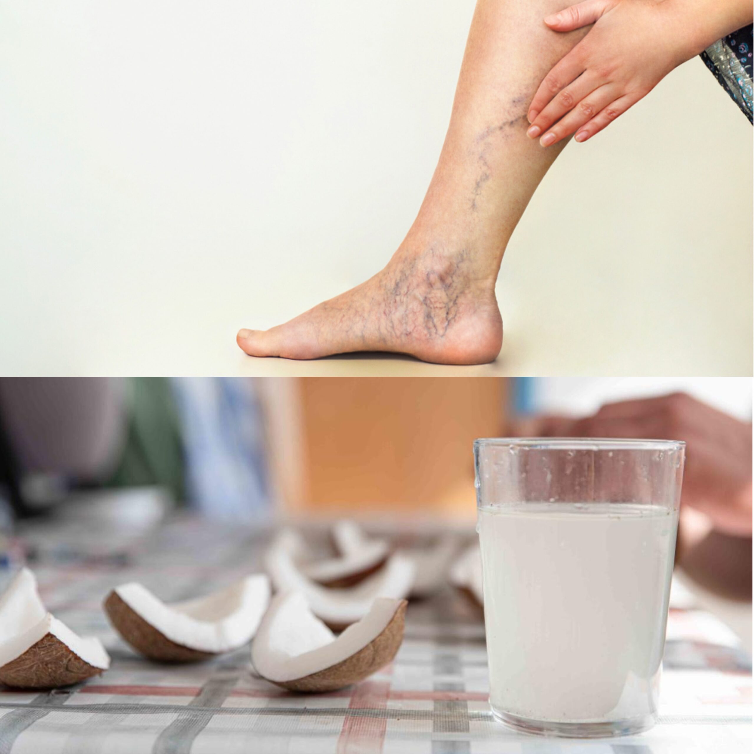 The Miracle of Coconut Water with Varicose Veins