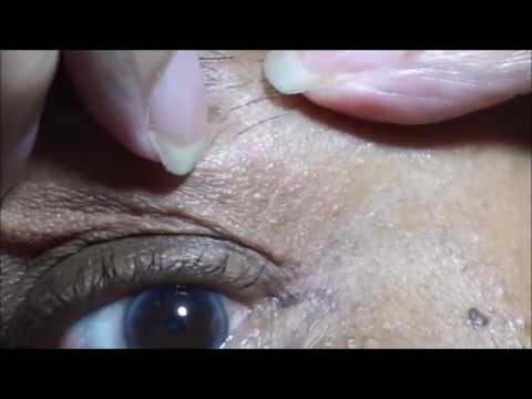 Skin Tag Removal with Apple Cider Vinegar