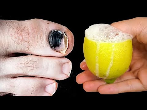 Nail Fungus Removal: 100% Natural Treatment for Toenail Fungus with Lemon and Salt