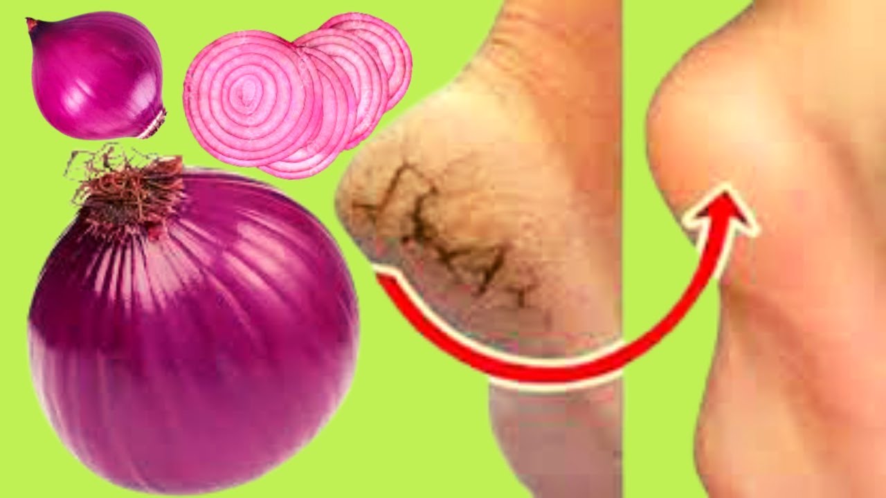 Remove Cracked Heels and Achieve Beautiful Feet Permanently: Home Remedy Using Red Onions