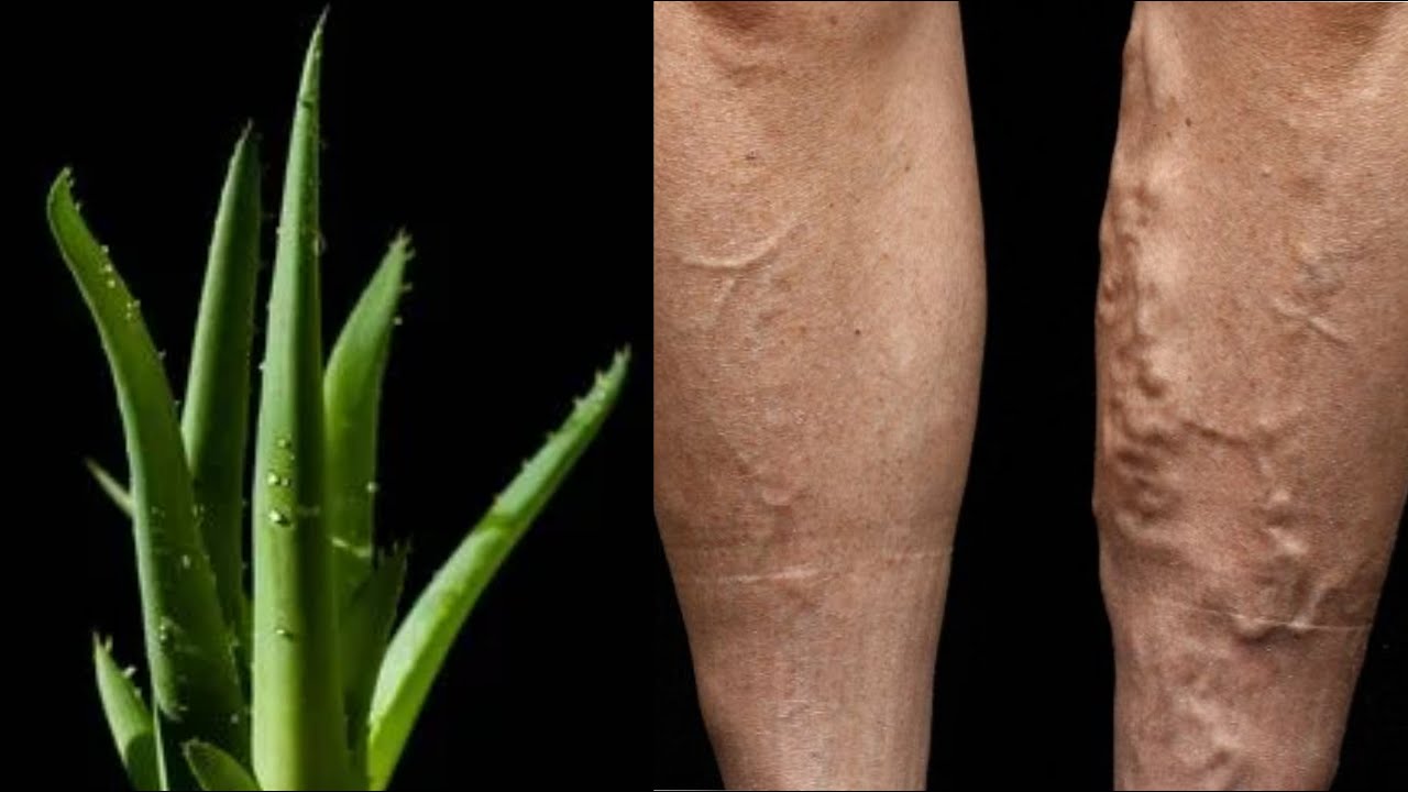 Unbelievable! Forget Varicose Veins Forever! Aloe Vera: The Treasure That Should Be in Every Home!