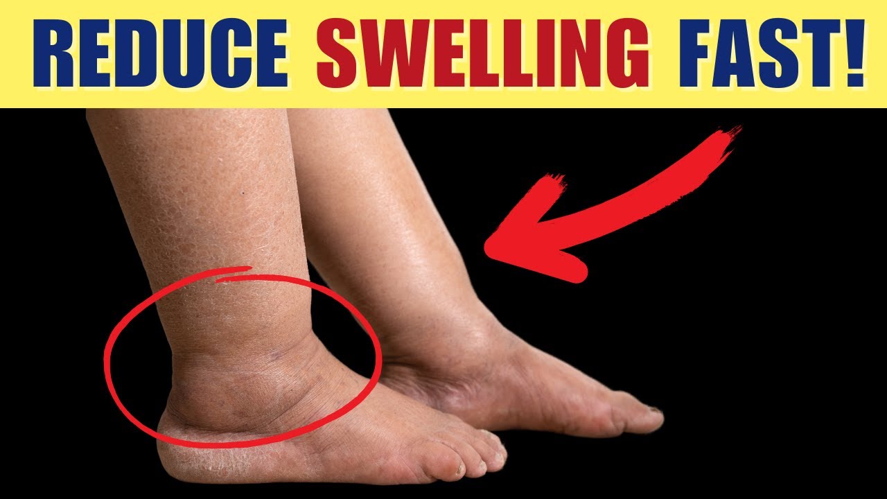 Best Vitamins to Remove Swelling in Legs and Feet