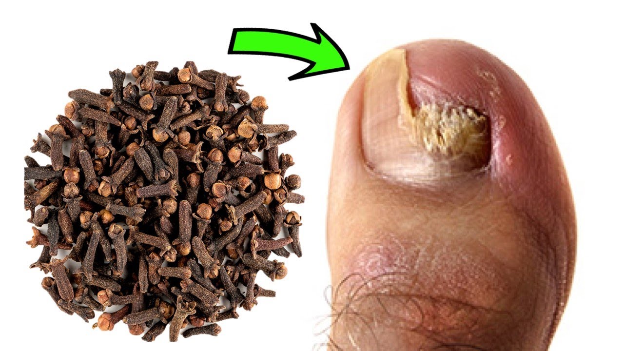 Say Goodbye to Toenail Fungus with Clove Oil! DIY Remedy