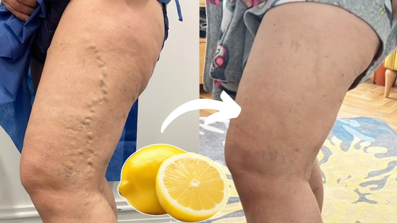 Lemon Removes Varicose Veins! This Is What You Need to Do…