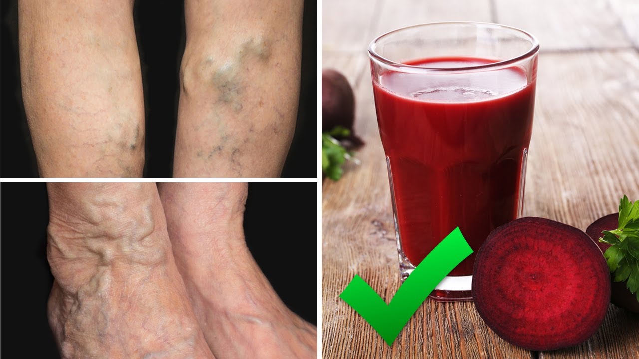 Drink This Juice to Prevent and Treat Varicose Veins