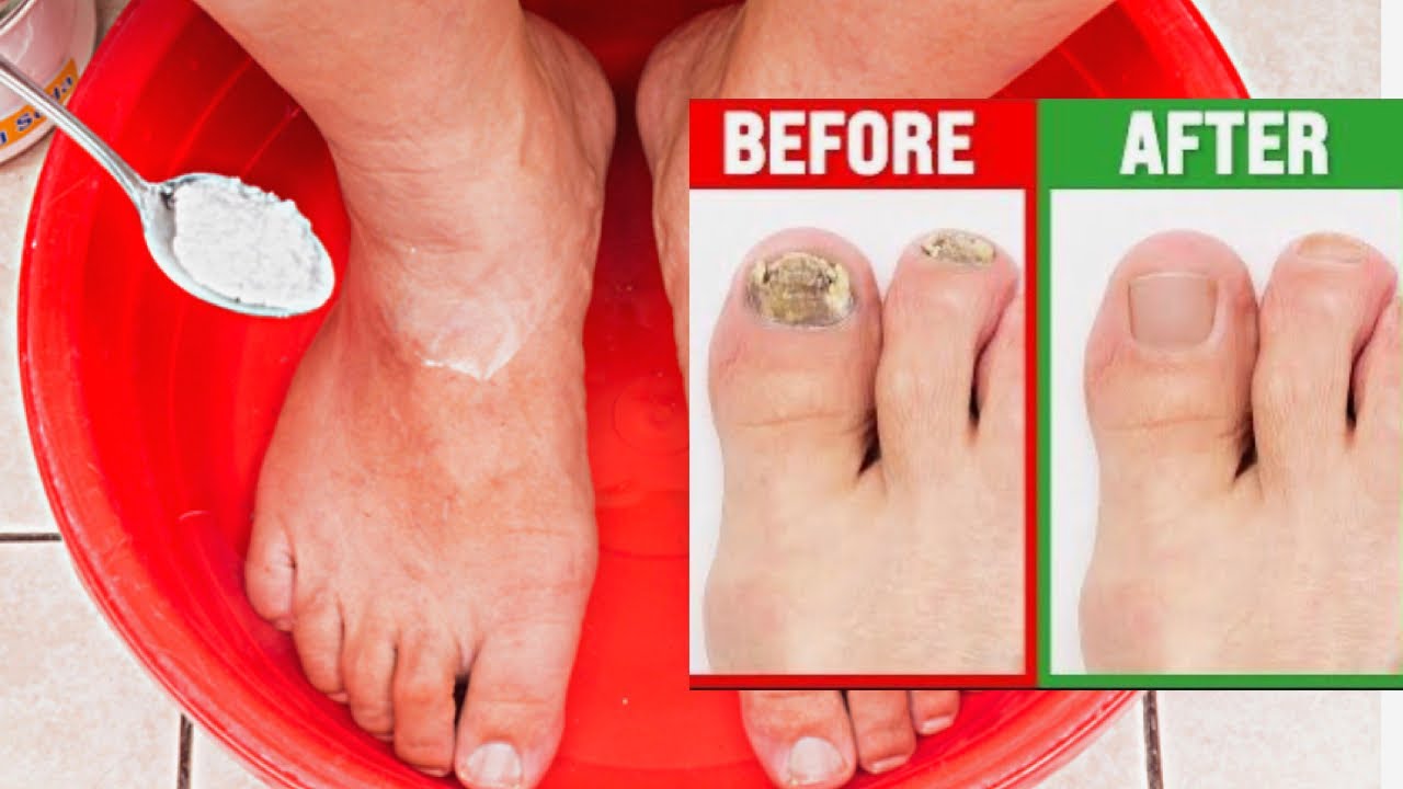 Nail Fungus Removal: 100% Natural Treatment for Toenail Fungus with Baking Soda