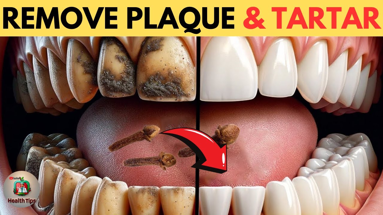 6 Natural Ways to Remove Plaque & Tartar Buildup