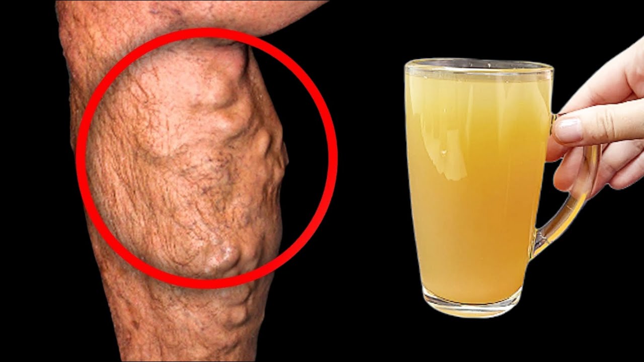 🔥 I AM SHOCKED! Instantly Dissolves Blood Clots and Makes the Blood Fluid with Apple and Lemon Juice!