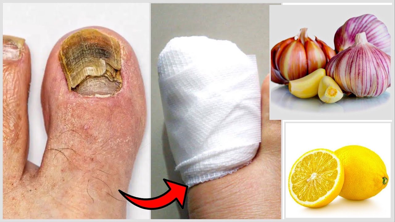 Lemon and Garlic Remedy for Nail Fungus and Excessive Sweating