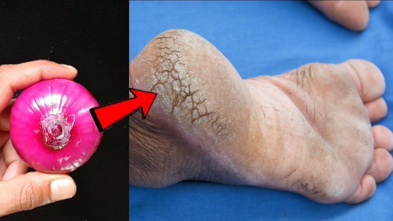 Remove Cracked Heels and Get Beautiful Feet Permanently: Magical Home Remedy with Red Onions