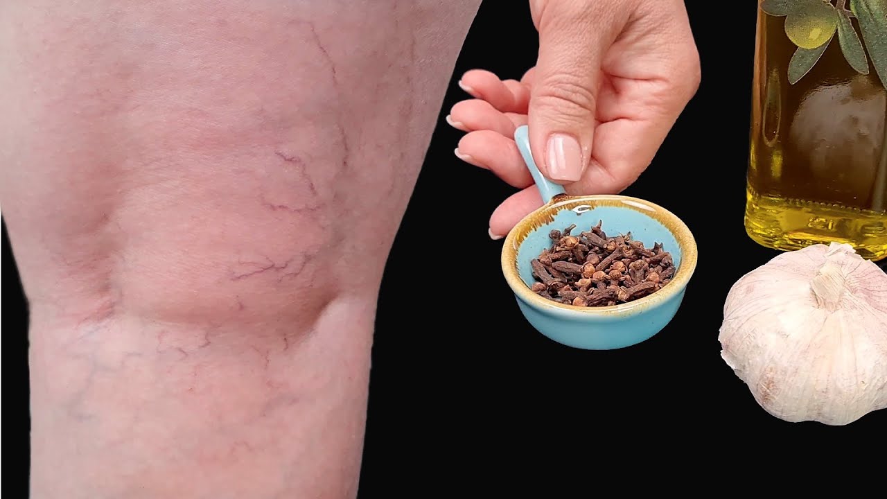 Leg Pain, Rheumatism, Varicose Veins, Arthritis – My Mother Couldn’t Walk Because of Pain 🧄 Garlic and Cloves Remedy