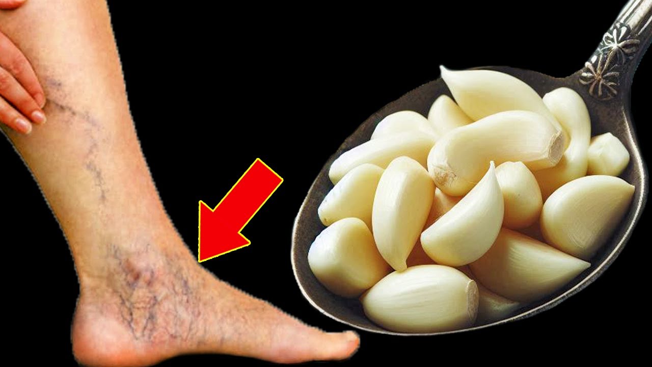 Varicose Veins, Leg Pain, Rheumatism, Arthritis, Headache, Joint Pain – Natural Remedy with Garlic