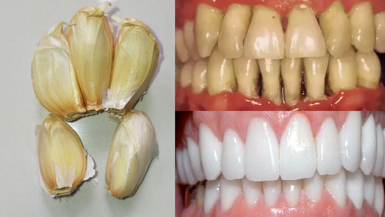 Secret Dentists Don’t Want You to Know: Remove Tartar and Whiten Teeth in Just 2 Minutes Using Garlic! 🪥🦷