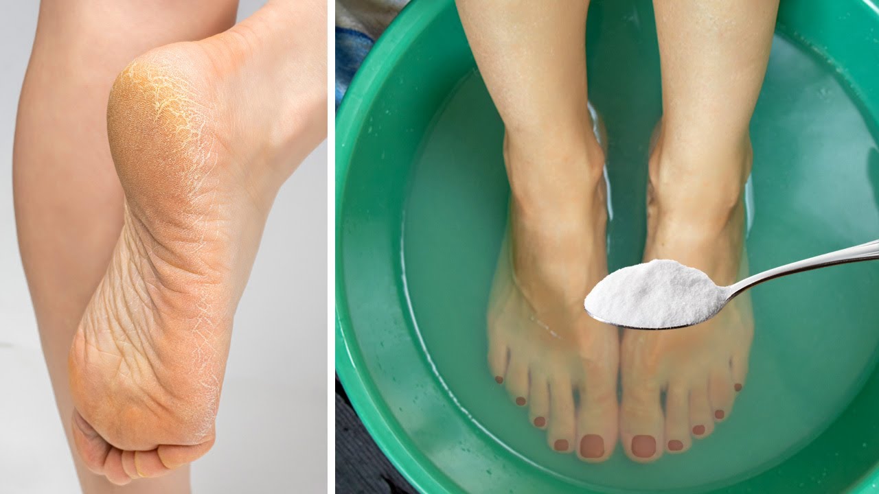 Get Rid of CRACKED HEELS Permanently – Magical Home Remedy