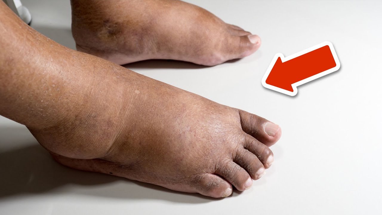 The Best Vitamin to Remove Swelling in Feet and Legs