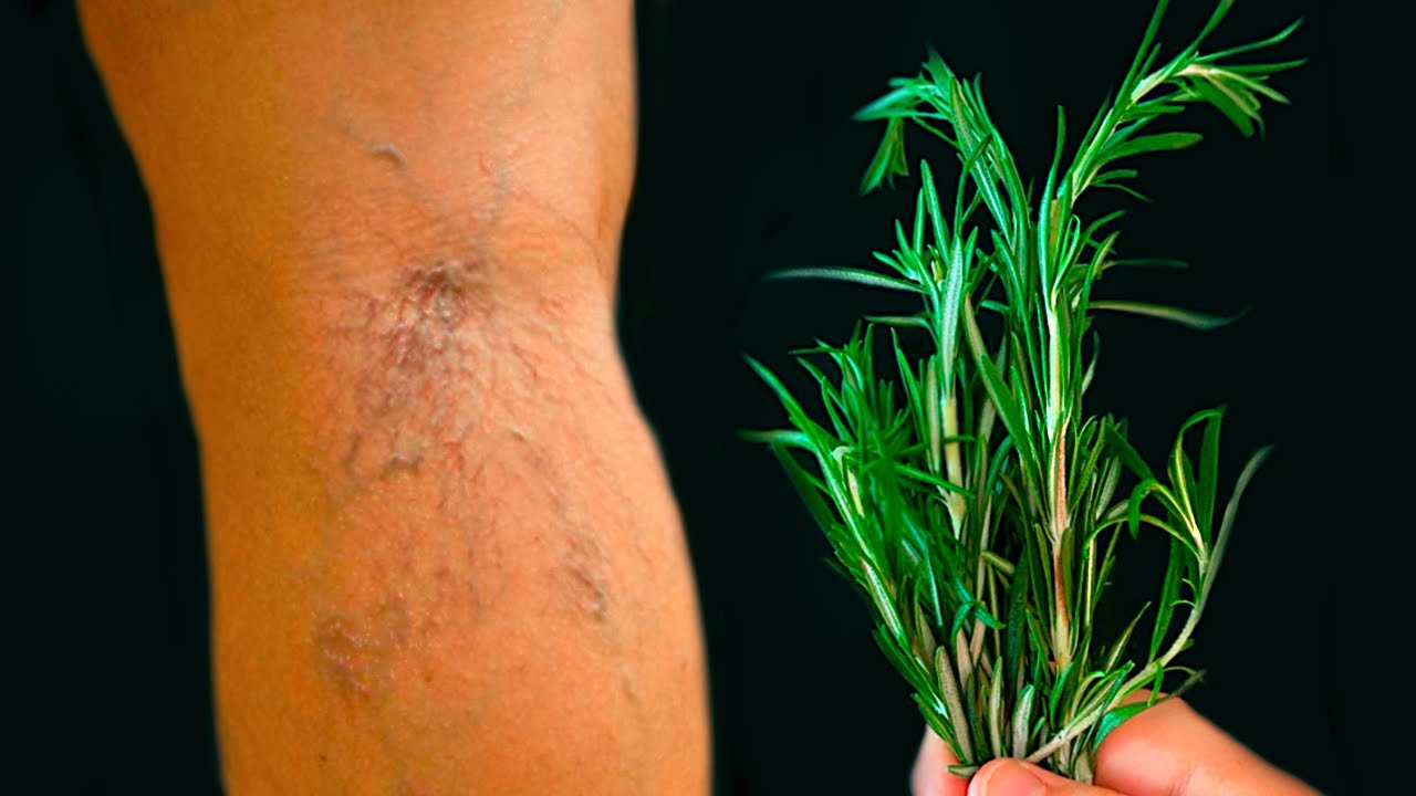 You Can Get Rid of Varicose Veins with Rosemary: This is a Real Treasure!