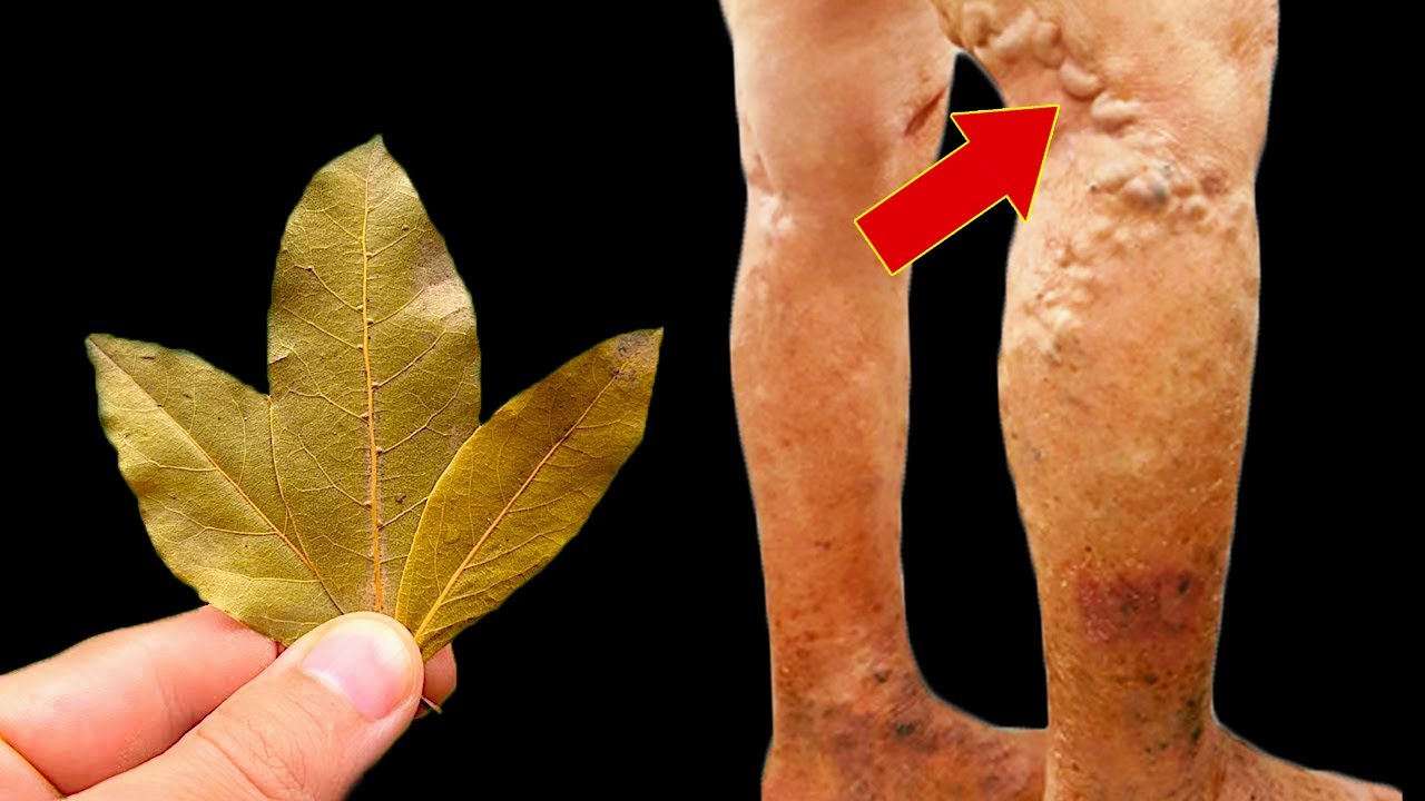 Amazing! Use Bay Leaves and Don’t Spend Any More Money at the Pharmacy (Did You Know That?) for Varicose Veins