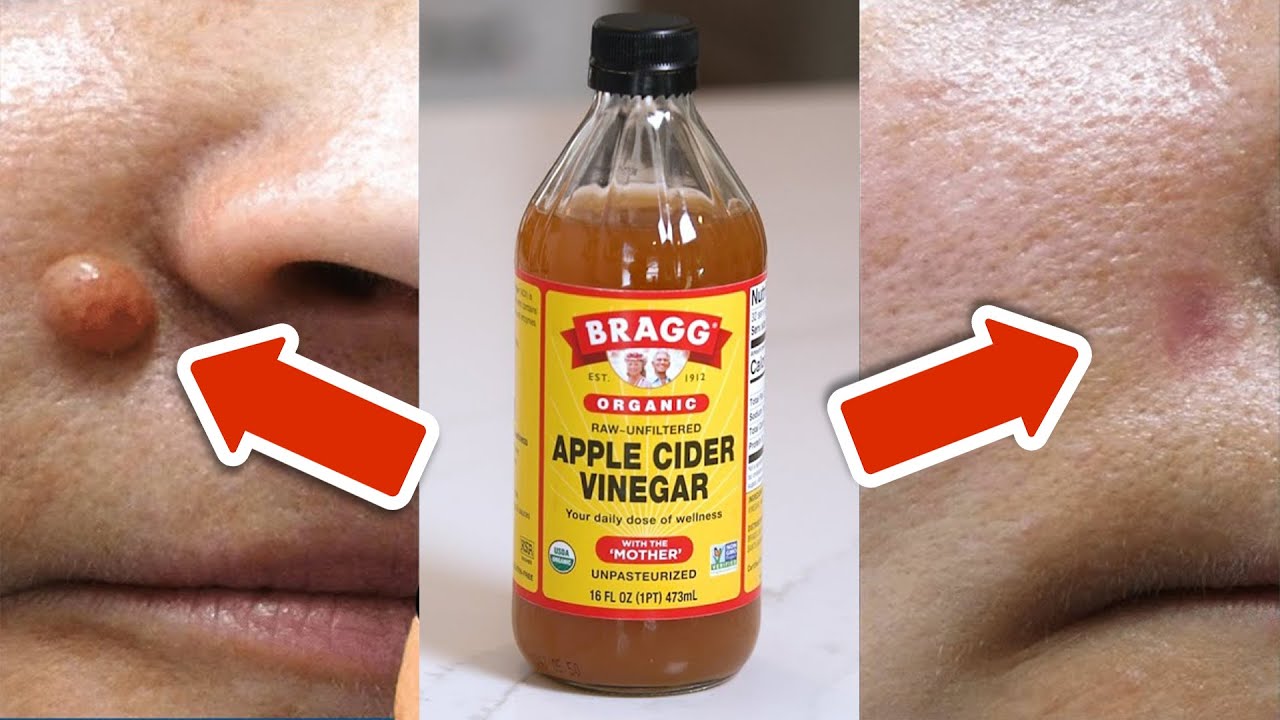 Apple Cider Vinegar Removes Warts in Just 24 Hours 💥 (Incredibly Easy) 🤯