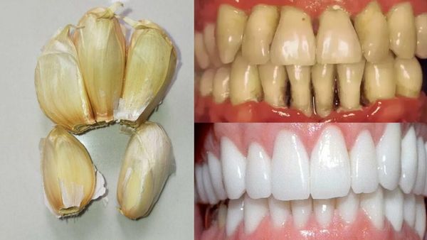 The Power of Garlic in Oral Health