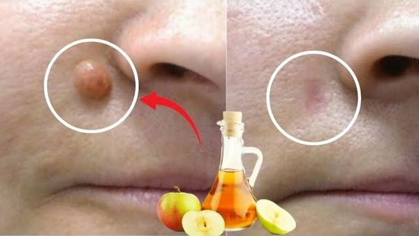 Discover the Power of Apple Cider Vinegar in Removing Warts