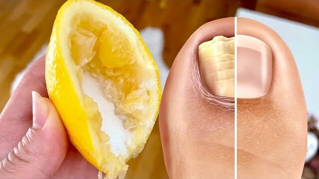 Nail Fungus Removal: 100% Natural Treatment for Toenail Fungus Using Lemon and Salt