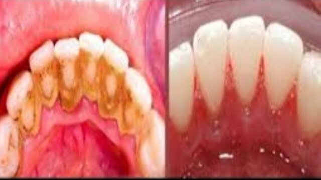 DIY Dental Plaque Removal: Quick and Easy Home Remedy