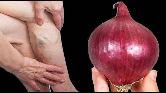 Mom’s Natural Remedy for Leg Pain, Rheumatism, Varicose Veins, Arthritis, Headache, and Joint Pain: Red Onion