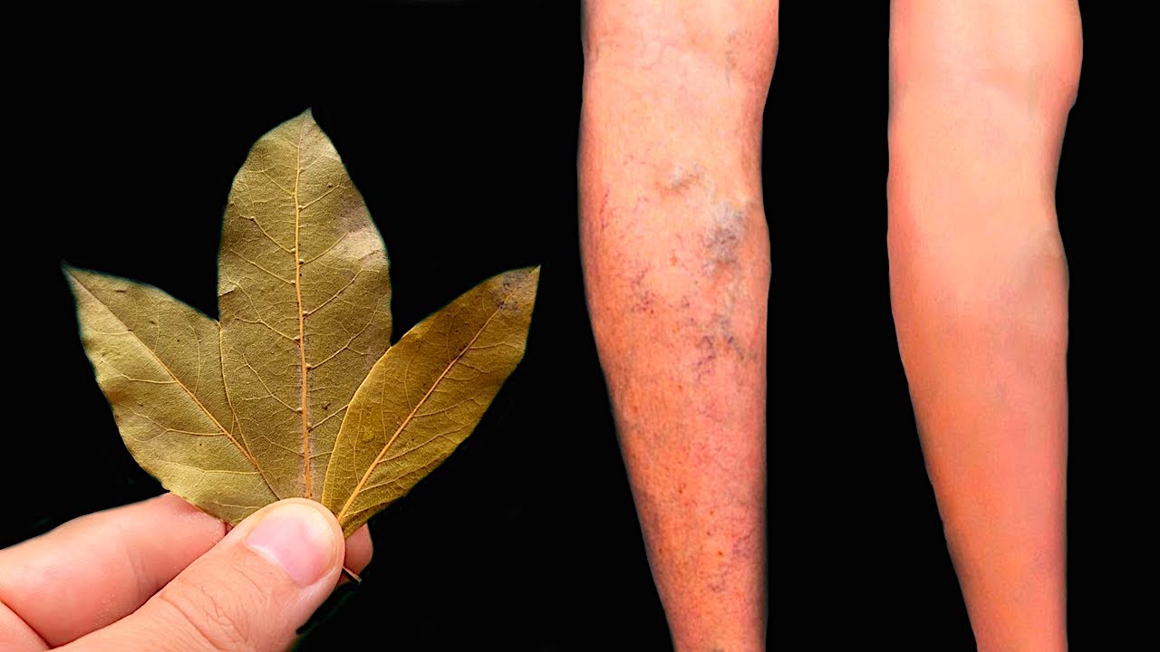 Unbelievable! Get Rid of Varicose Veins with Bay Leaf – This Treasure Should Be in Every Home