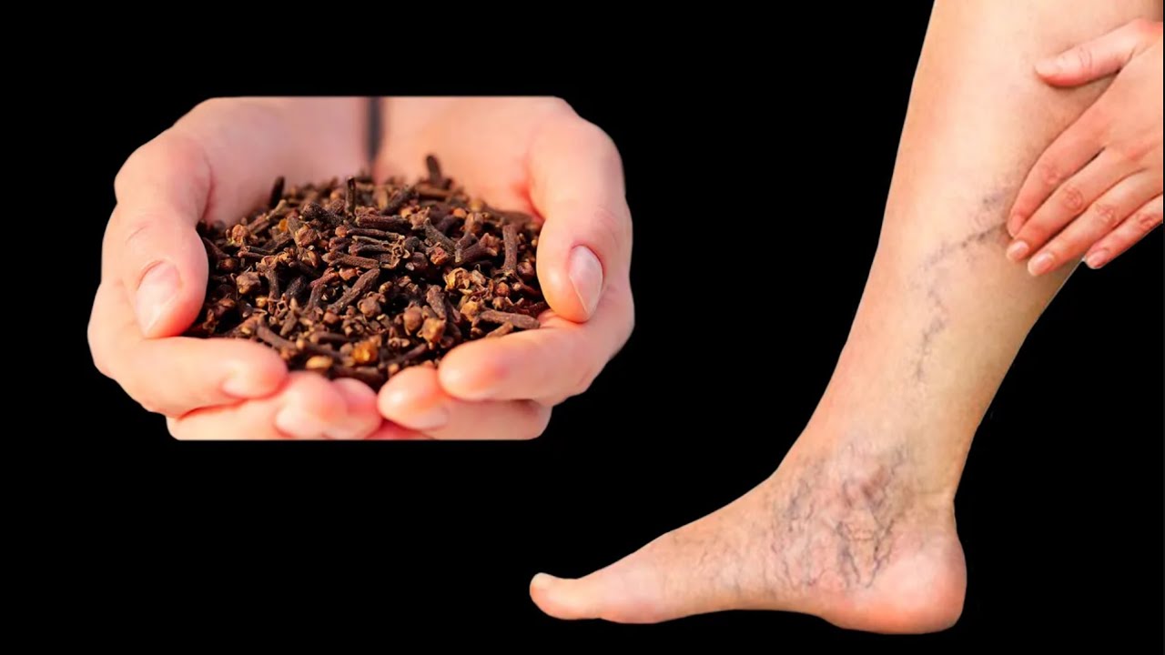 Incredible! 😲 This Remedy Destroys Varicose Veins! Say Goodbye to Them Forever with Cloves!