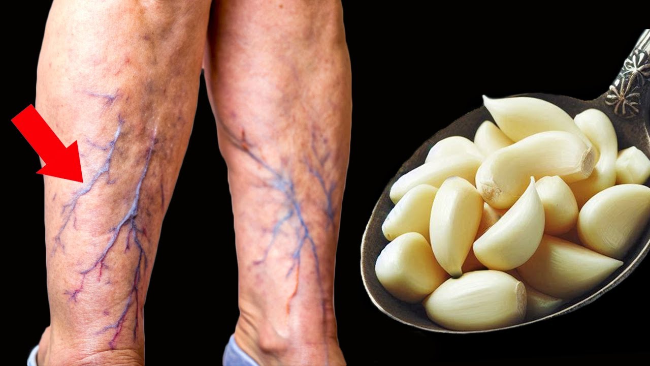 Unbelievable! 🤩 Garlic Destroys Varicose Veins and Reduces Inflammation Naturally (Did You Know That?)