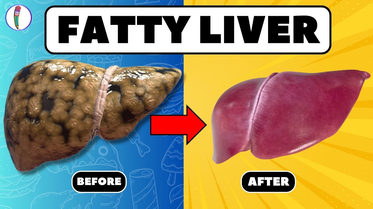 Strictly Avoid These 5 Foods if You Have Fatty Liver | Fatty Liver Treatment | Liver Disease 🍟🚫