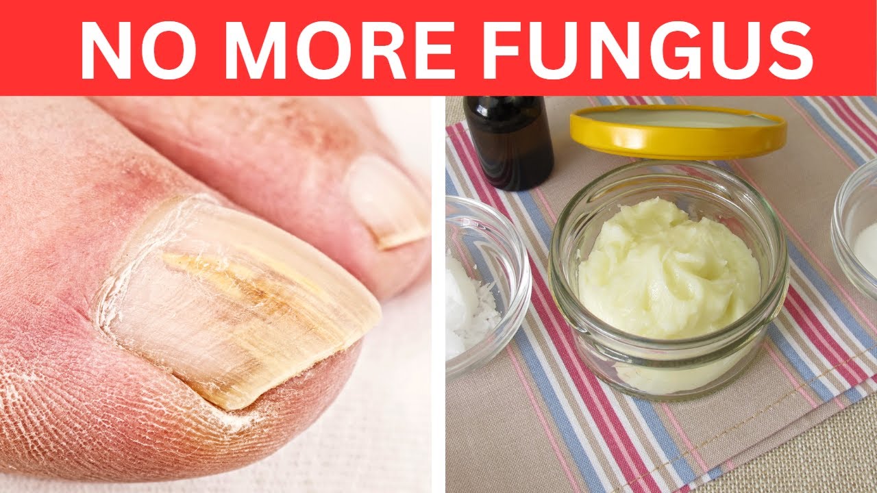 Garlic Paste: The Secret to Banishing Toenail Fungus for Good