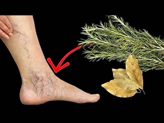 Unbelievable! My Grandmother Got Rid of Varicose Veins with This Remedy: Rosemary and Bay Leaves Erase Varicose Veins!