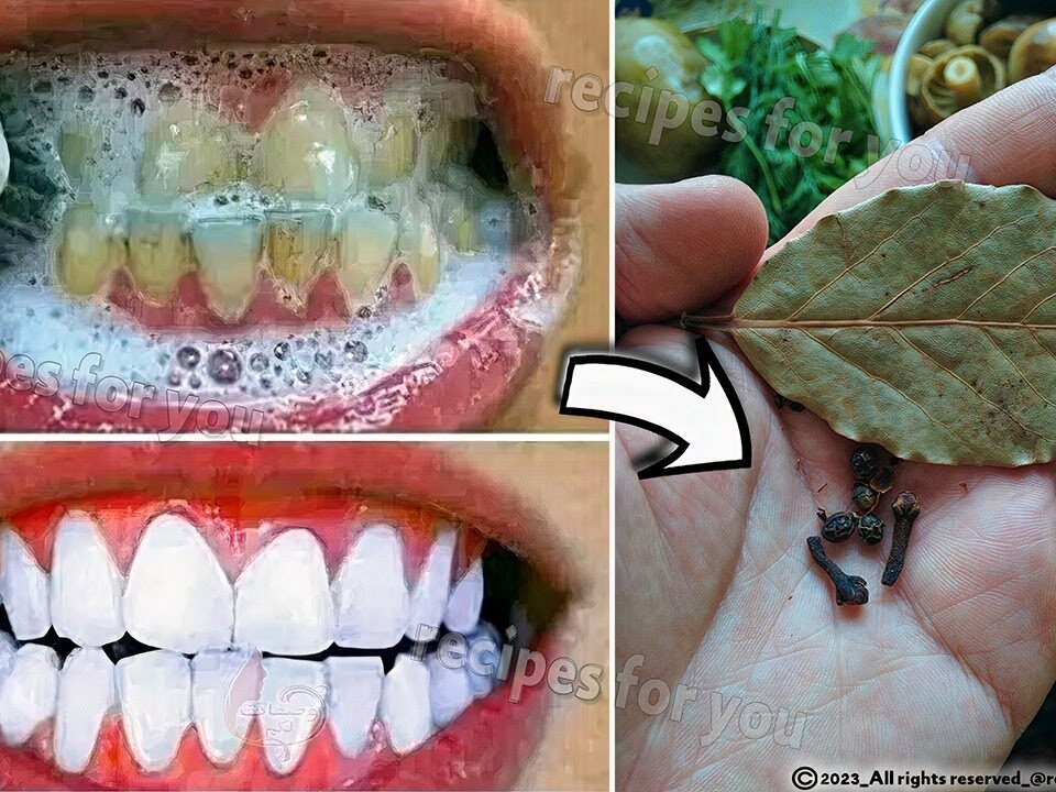 The Secret Dentists Don’t Want You to Know: Remove Tartar and Whiten Teeth in Just 2 Minutes Using Cloves and Bay Leaves