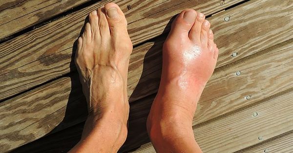 In only 3 days, his gout disappeared when he drank a natural juice