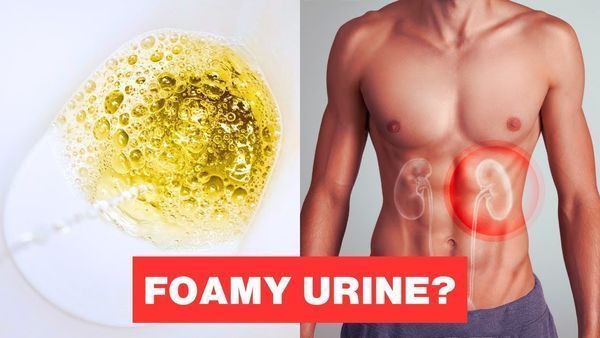 If Your Urine Is Foamy Like This, It Could Be A Warning Sign! (Proteinuria)